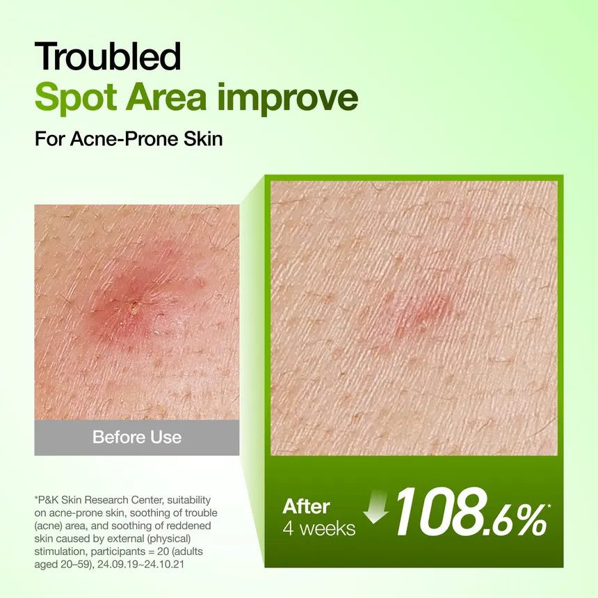 anua  Azelaic Acid 10 Hyaluron Redness Soothing Serum Set Kpop Demon Hunter